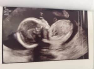 ultrasound